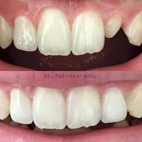 Before and after Emax veneers at WestDent Clinic – improved tooth shape and color result