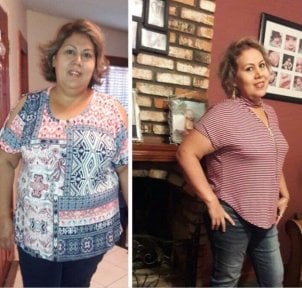Before and after gastric bypass results at Hospital de la Familia, visible weight loss achieved