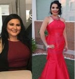 Before and after gastric bypass results at Hospital de la Familia, visible weight loss transformation