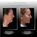 Résultat avant/après lifting par fils d'acide hyaluronique à la clinique Dr Manavbasi