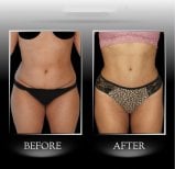 Before and after Vaser 3 areas plus tummy tuck results at Dr. Ilker Manavbasi's Clinic