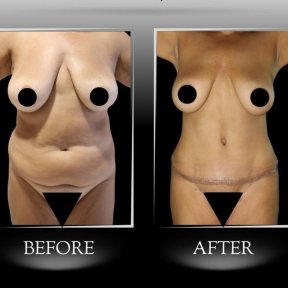 Résultats avant-après Vaser 3 zones et abdominoplastie à la clinique Dr Ilker Manavbasi