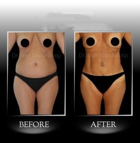 Before and after Vaser 3 areas plus tummy tuck results at Dr. Ilker Manavbasi's Clinic