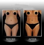Before and after Vaser 3 areas plus tummy tuck results at Dr. Ilker Manavbasi's Clinic