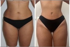 Before and after Vaser 3 Areas plus tummy tuck results at Dr. Ilker Manavbasi's Clinic