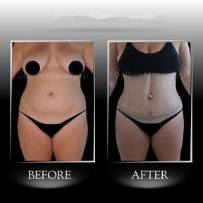 Before and after Vaser 3 Areas plus tummy tuck results at Dr. Ilker Manavbasi's Clinic