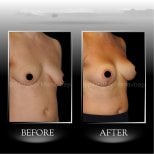 Before and after breast implants with lift results at Dr. Ilker Manavbasi's Clinic