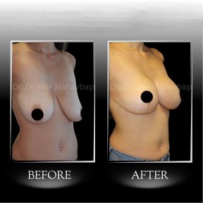 Результати до і після імплантів грудей з підтяжкою в клініці доктора Ілкера Манавбаші