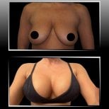 Before and after breast implants with lift results at Dr. Ilker Manavbasi's Clinic