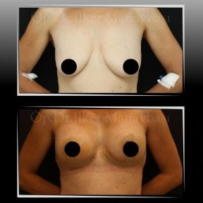 Before and after breast implants with lift results at Dr. Ilker Manavbasi's Clinic