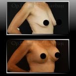 Before and after breast implants with lift results at Dr. Ilker Manavbasi's Clinic