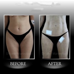 نتائج شفط الدهون فايزر قبل وبعد في عيادة د. إيلكر مانافباشي، البطن والفخذين