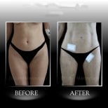 نتائج شفط الدهون فايزر قبل وبعد في عيادة د. إيلكر مانافباشي، البطن والفخذين
