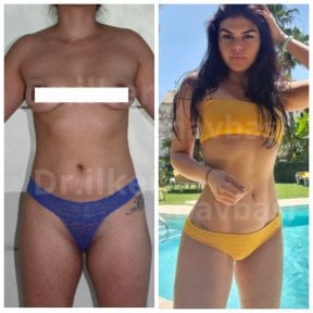 Результати до і після Vaser ліпосакції в клініці Dr. Ilker Manavbasi, корекція фігури