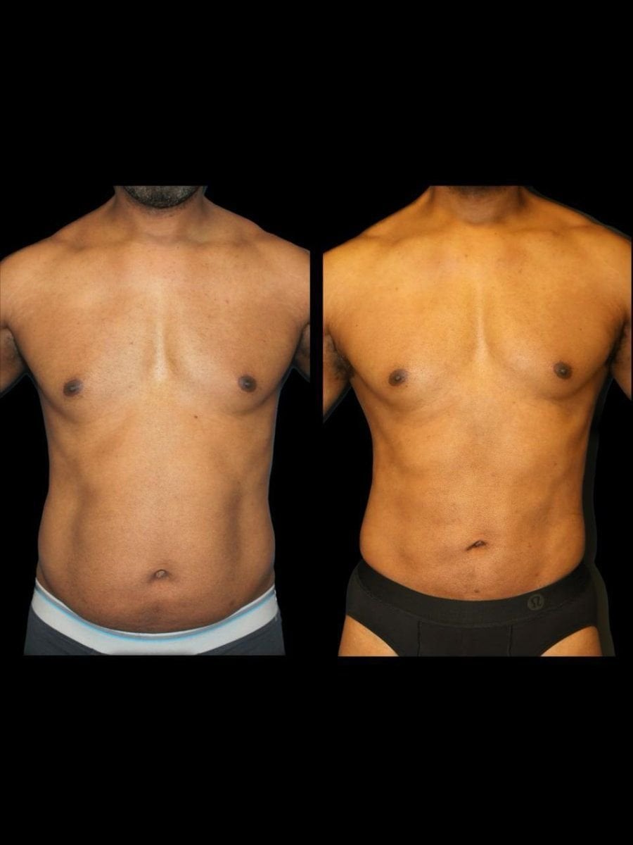 Resultados antes y después de Vaser lipo en Dr. Ilker Manavbasi's Clinic, contorno abdominal masculino