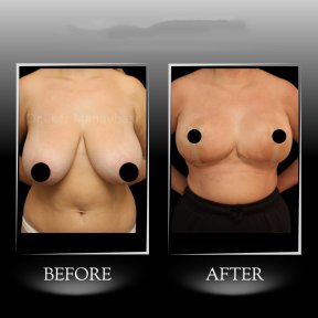 Vorher-nachher-Ergebnis Bruststraffung in Dr. Ilker Manavbasi's Klinik, verbesserte Kontur