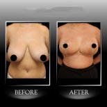 Vorher-nachher-Ergebnis Bruststraffung in Dr. Ilker Manavbasi's Klinik, verbesserte Kontur