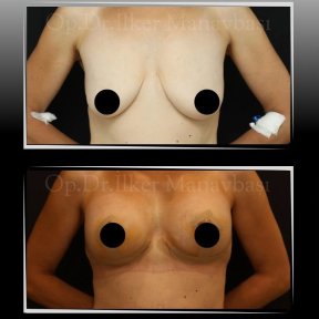 Vorher-nachher-Ergebnis Bruststraffung bei Dr. Ilker Manavbasi, verbesserte Kontur