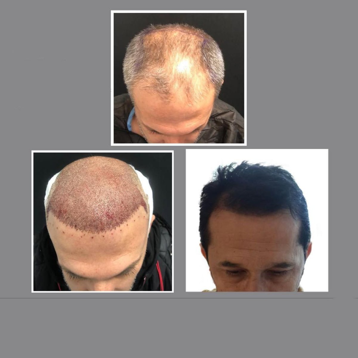 نتائج زراعة الشعر FUE قبل وبعد في عيادة Dr. Ilker Manavbasi، استعادة خط الشعر