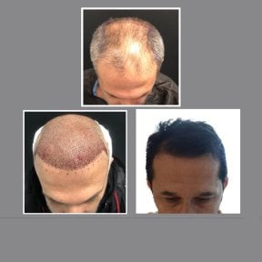 FUE hair transplant before and after results at Dr. Ilker Manavbasi's Clinic, restored hairline