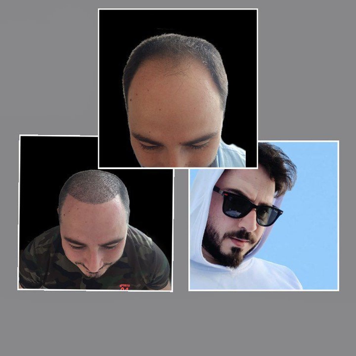 نتائج زراعة الشعر FUE قبل وبعد في عيادة د. إيلكر مانافباشي، استعادة خط الشعر