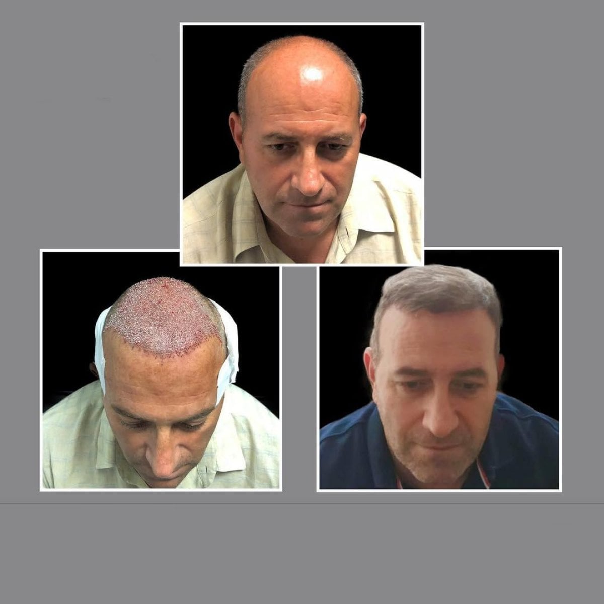 نتائج زراعة الشعر FUE قبل وبعد في عيادة د. إيلكر مانافباشي، استعادة خط الشعر