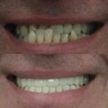Hollywood Smile before and after results at Excelentis Dental Center, smile makeover outcome
