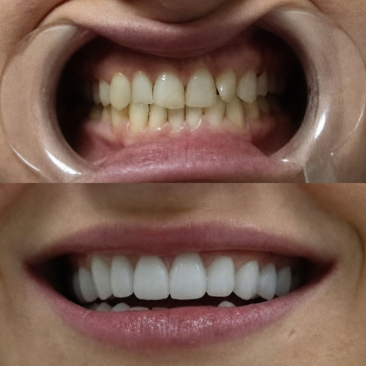 نتائج قبل وبعد ابتسامة هوليوود في Excelentis Dental Center، تبييض الأسنان والفينير