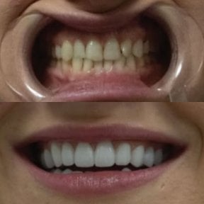 Before and after Hollywood Smile results at Excelentis Dental Center, teeth whitening and veneers