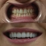 Before and after Hollywood Smile results at Excelentis Dental Center, teeth whitening and veneers