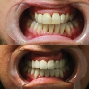 Before and after Hollywood Smile results at Excelentis Dental Center, whiter even teeth