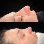 Результаты ринопластики до и после в Soraca Med, коррекция профиля носа