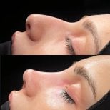 Результаты ринопластики до и после в Soraca Med, улучшенный профиль и контур носа