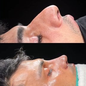 Результаты ринопластики до и после в Soraca Med, улучшенная форма и профиль носа