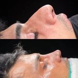 Результаты ринопластики до и после в Soraca Med, улучшенная форма и профиль носа