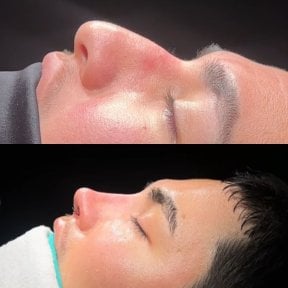 Результат ринопластики до и после в Soraca Med, улучшенная форма и профиль носа