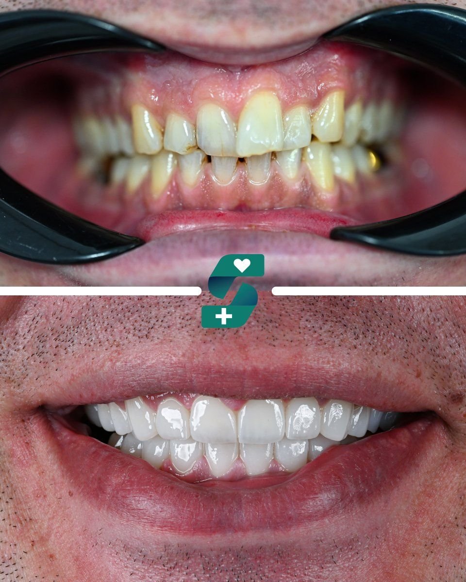قبل وبعد تركيب تيجان البورسلين في Soraca Med، تحول ملحوظ في الابتسامة