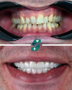 Before and after porcelain crown installation at Soraca Med, visible smile transformation result