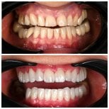 Before and after porcelain crown installation at Soraca Med, visible smile transformation result