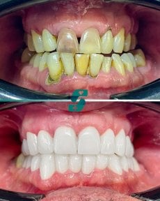 Porcelain crown installation before and after results at Soraca Med – smile restoration