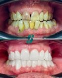 Porcelain crown installation before and after results at Soraca Med – smile restoration