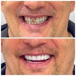 Porcelain crown installation before and after results at Soraca Med – improved smile aesthetics