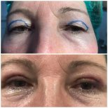 Blepharoplasty before and after results at Italian Eye Hospital, upper eyelid correction