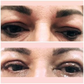 Before and after blepharoplasty results at Italian Eye Hospital, upper eyelid correction