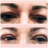 Before and after blepharoplasty results at Italian Eye Hospital, upper eyelid correction