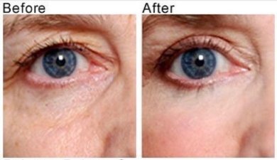 Before and after blepharoplasty results at Italian Eye Hospital, eyelid correction improvement