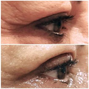 Blepharoplasty before and after results at Italian Eye Hospital, eyelid correction improvement