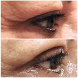 Blepharoplasty before and after results at Italian Eye Hospital, eyelid correction improvement