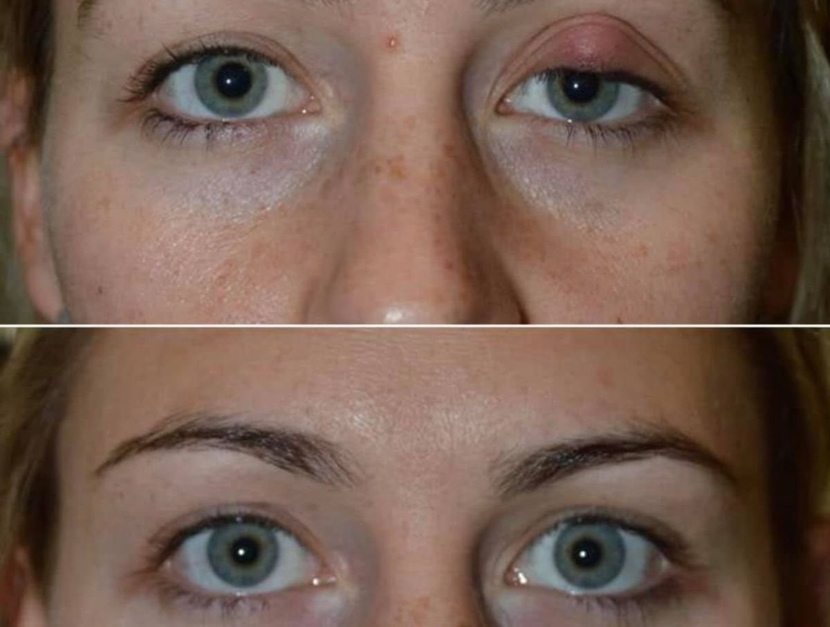 Resultados de blefaroplastia antes y después en Italian Eye Hospital, corrección de párpado