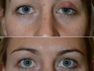 Blepharoplasty before and after results at Italian Eye Hospital, upper eyelid correction outcome